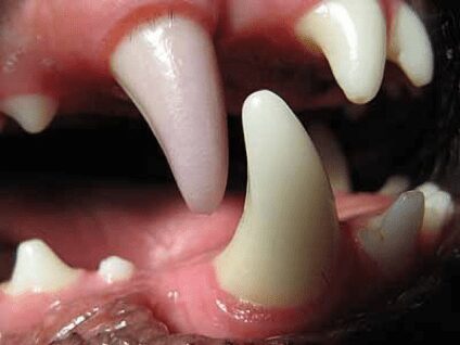 tooth discoloration